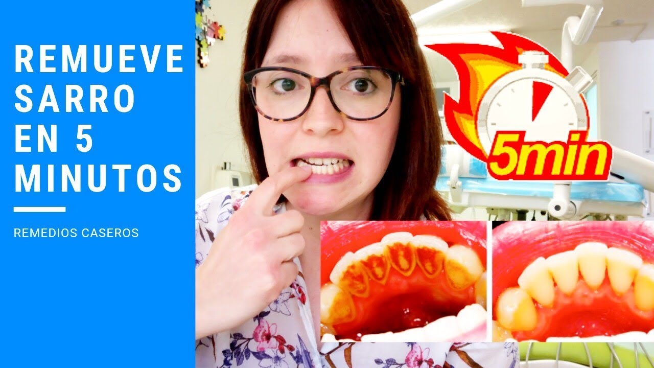 como quitar el sarro delos dientes remedios caseros