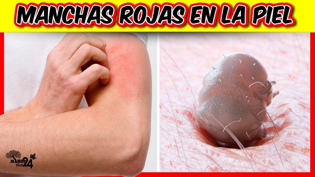 mancha roja en la piel con dolor